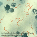 Studiu de caz ANGINA ACUTĂ CU STREPTOCOCCUS PYOGENES