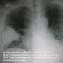 Studiu de caz PNEUMONIE ACUTA COMUNITARA CU STREPTOCOCCUS PNEUMONIAE